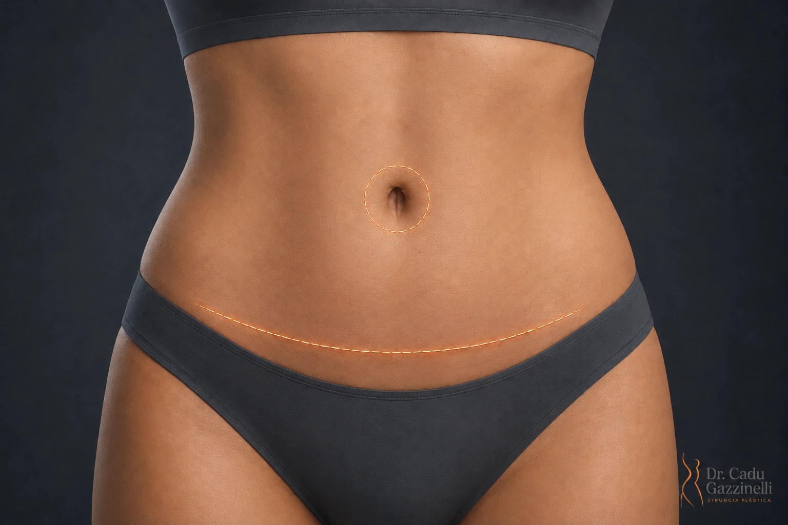 Marcação da cicatriz da abdominoplastia: linha horizontal baixa acima da região púbica e contorno ao redor do umbigo