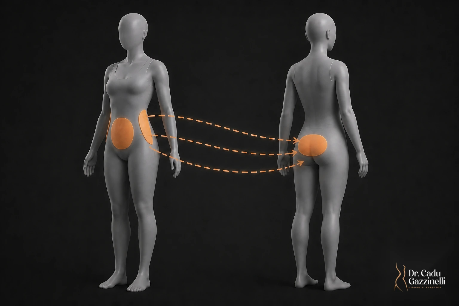 Diagrama do fluxo da lipoescultura: gordura retirada do abdômen e dos flancos e reinjetada na região glútea