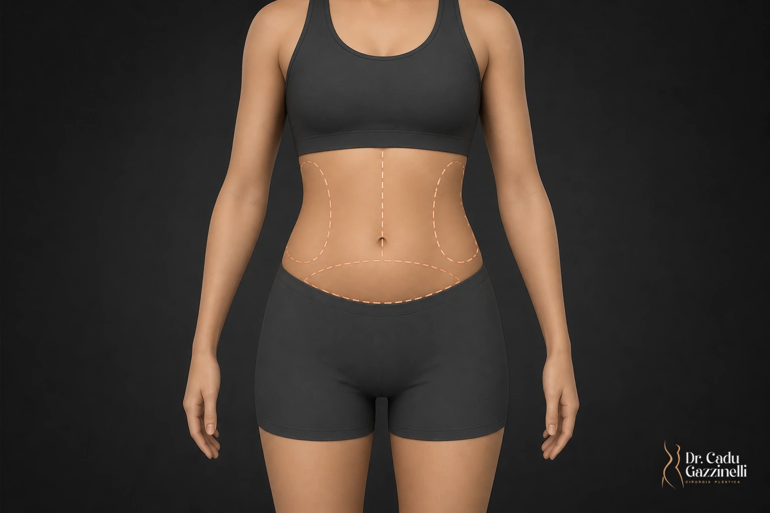 Torso feminino com três regiões do abdômen demarcadas: excesso de pele abaixo do umbigo, gordura localizada nos flancos e diástase na linha média
