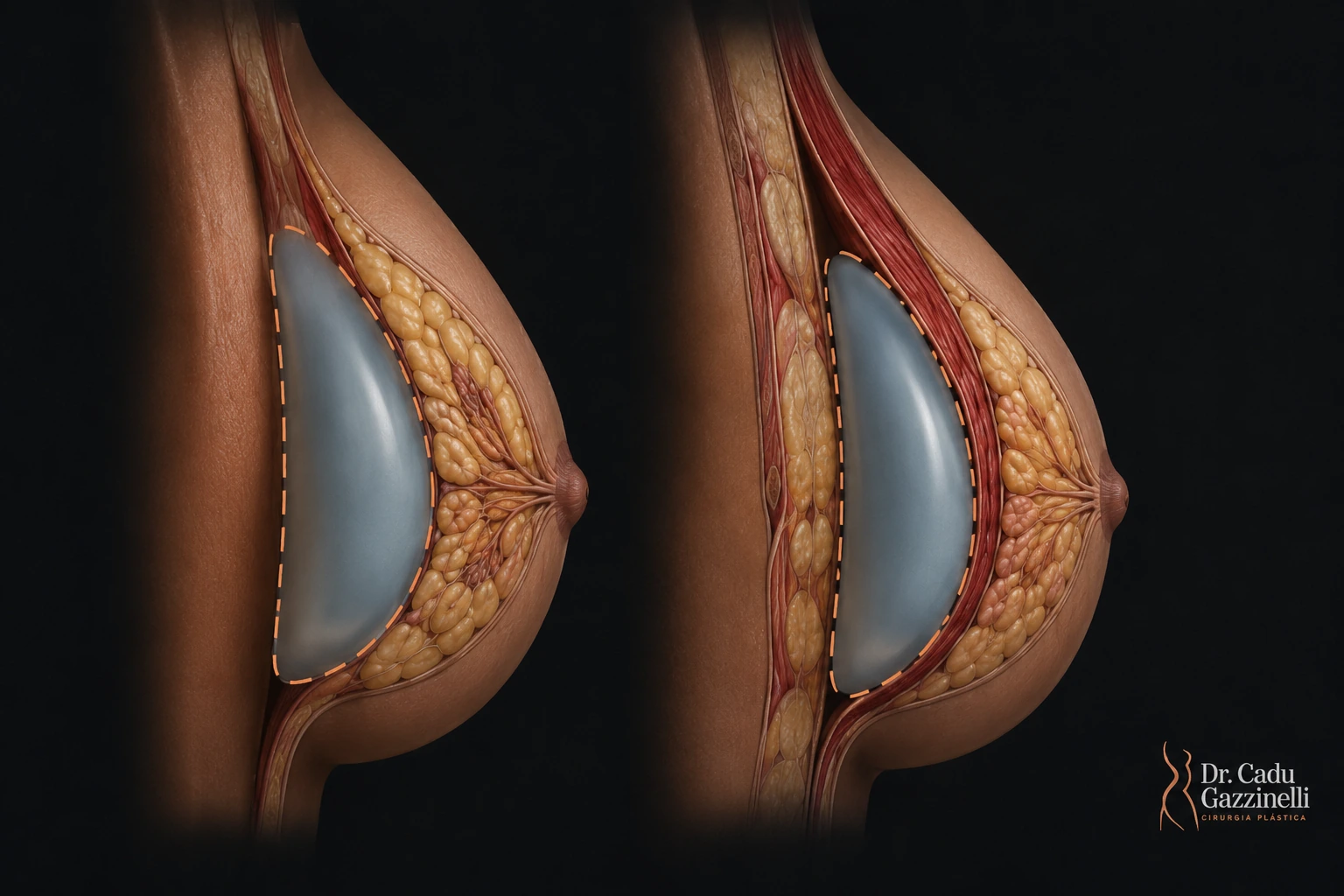 Ilustração anatômica comparando os dois planos de colocação do implante mamário: subglandular e submuscular