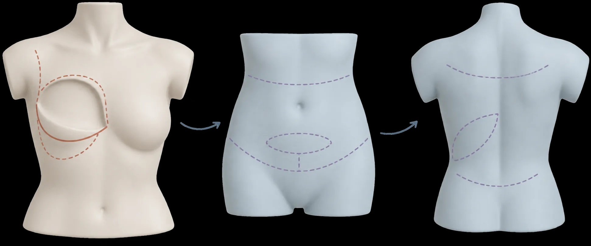 Mapa didático das possíveis áreas de cicatriz conforme a técnica de reconstrução