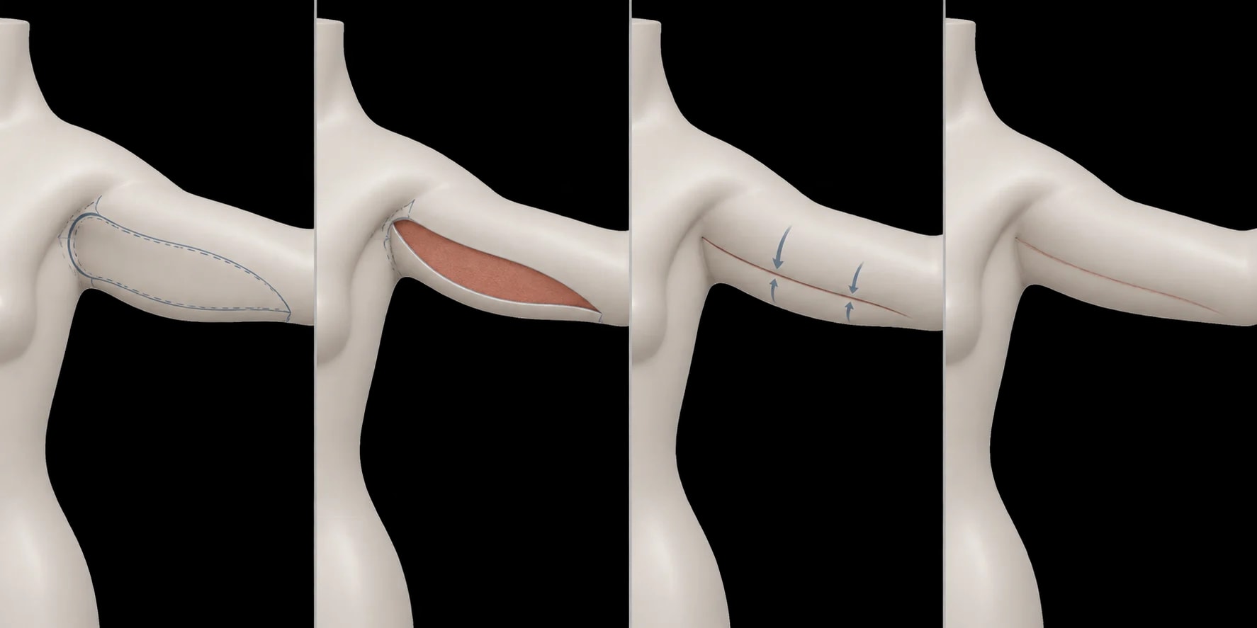 Prancha didática em modelo de braço sintético mostrando planejamento, retirada esquemática de pele e fechamento da braquioplastia.