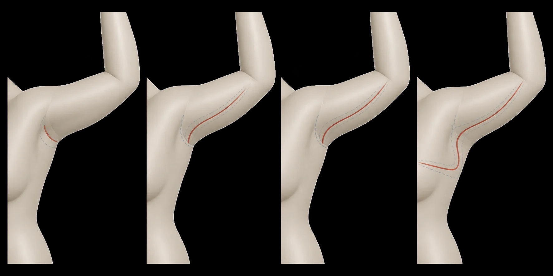 Mapa didático em modelo sintético com possibilidades de extensão da cicatriz da braquioplastia.