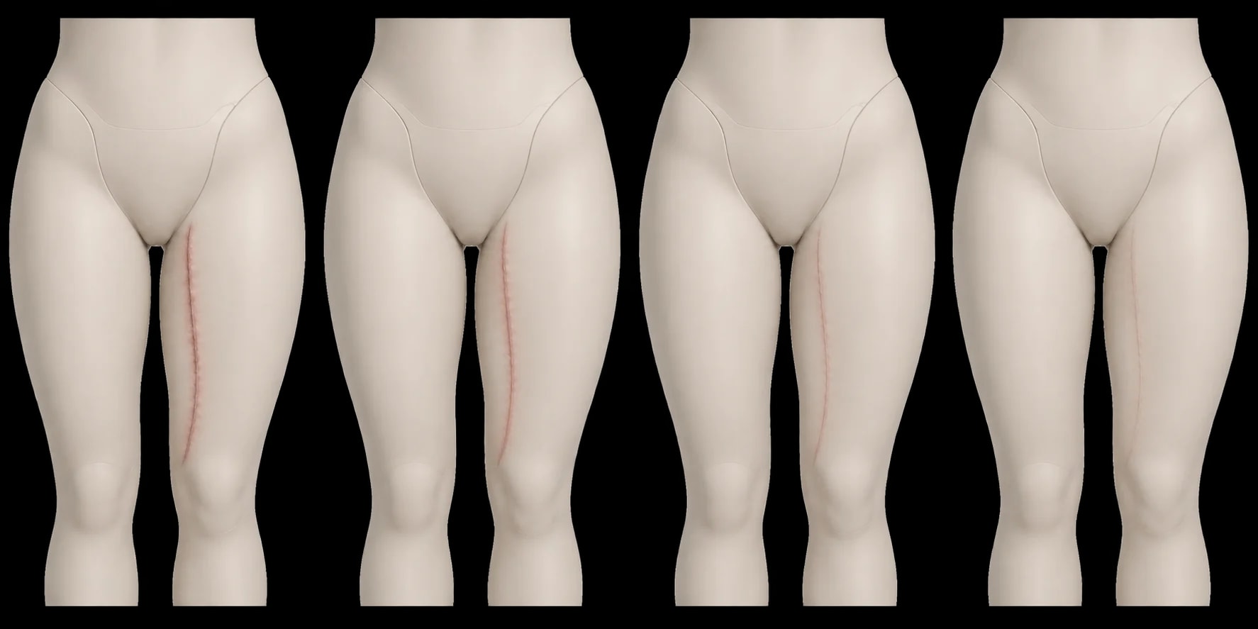 Sequência didática em modelo sintético sobre a evolução visual da cicatriz da cirurgia de coxas.