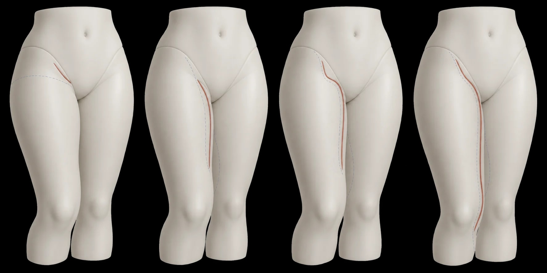 Mapa didático em modelo sintético com possibilidades de extensão da cicatriz da cirurgia de coxas.